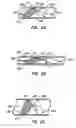 Fig. 03 - Endoluminal filter