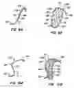Fig. 08 - Endoluminal filter