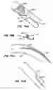 Fig. 40 - Endoluminal filter