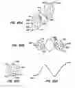 Fig. 49 - Endoluminal filter