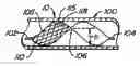 Fig. 01 - Lumen filtering methods