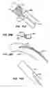 Fig. 40 - Lumen filtering methods