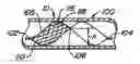 Fig. 01 - Methods for maintaining a filtering device within a lumen