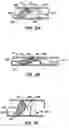 Fig. 03 - Methods for maintaining a filtering device within a lumen