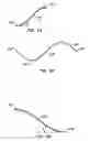 Fig. 06 - Methods for maintaining a filtering device within a lumen