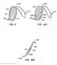 Fig. 09 - Methods for maintaining a filtering device within a lumen