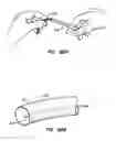 Fig. 34 - Methods for maintaining a filtering device within a lumen