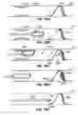 Fig. 43 - Methods for maintaining a filtering device within a lumen