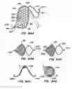 Fig. 48 - Methods for maintaining a filtering device within a lumen