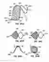 Fig. 48 - Coated endoluminal filter