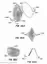 Fig. 50 - Coated endoluminal filter
