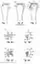 Fig. 02 - Suture fixation device and method for surgical repair