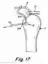 Fig. 07 - Suture fixation device and method for surgical repair