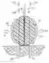 Fig. 01 - Method of using ultrasonic vibration to secure body tissue with fastening element