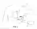 Fig. 02 - Level crossing detector for detecting noise, sinus rhythm and ventricular fibrillation in subcutaneous or body surface signals