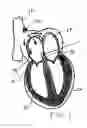 Fig. 02 - Atrial pacing lead