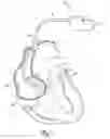 Fig. 02 - Self-deploying vascular occlusion device