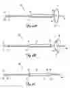 Fig. 03 - Self-deploying vascular occlusion device