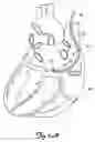 Fig. 10 - Self-deploying vascular occlusion device
