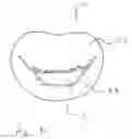 Fig. 17 - Blood flow controlling apparatus