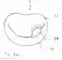 Fig. 20 - Blood flow controlling apparatus