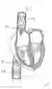 Fig. 32 - Blood flow controlling apparatus