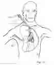 Fig. 50 - Blood flow controlling apparatus