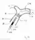Fig. 60 - Blood flow controlling apparatus