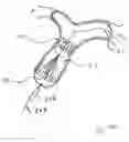 Fig. 61 - Blood flow controlling apparatus