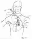 Fig. 62 - Blood flow controlling apparatus