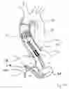 Fig. 64 - Blood flow controlling apparatus