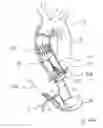 Fig. 65 - Blood flow controlling apparatus