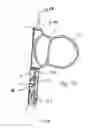 Fig. 72 - Blood flow controlling apparatus