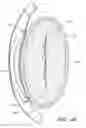 Fig. 04 - Dynamically adjustable implants and methods for reshaping tissue