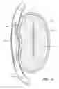 Fig. 08 - Dynamically adjustable implants and methods for reshaping tissue