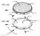 Fig. 06 - Spinal disc prosthesis and methods of use
