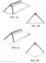 Fig. 04 - Spinal disc annulus reconstruction method and spinal disc annulus stent