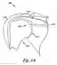 Fig. 02 - Humeral joint prosthesis