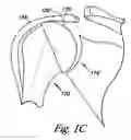 Fig. 04 - Humeral joint prosthesis