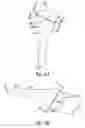 Fig. 08 - Humeral joint prosthesis