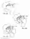 Fig. 07 - Modular resurfacing prosthetic