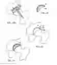 Fig. 08 - Modular resurfacing prosthetic
