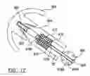 Fig. 09 - Modular resurfacing prosthetic