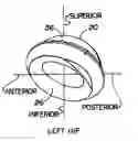 Fig. 01 - VARIABLE GEOMETRY RIM SURFACE ACETABULAR SHELL LINER