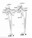 Fig. 03 - VARIABLE GEOMETRY RIM SURFACE ACETABULAR SHELL LINER