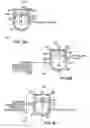 Fig. 05 - Reducing effect of magnetic and electromagnetic fields on an implant's magnet and/or electronics