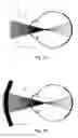 Fig. 02 - Specially coherent optics
