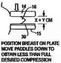 Fig. 01 - Mammography procedure and apparatus for reducing pain when compressing a breast