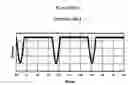 Fig. 02 - Pulseless peristaltic pump