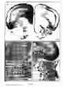 Fig. 10 - Method of treating a disorder by suicide gene therapy